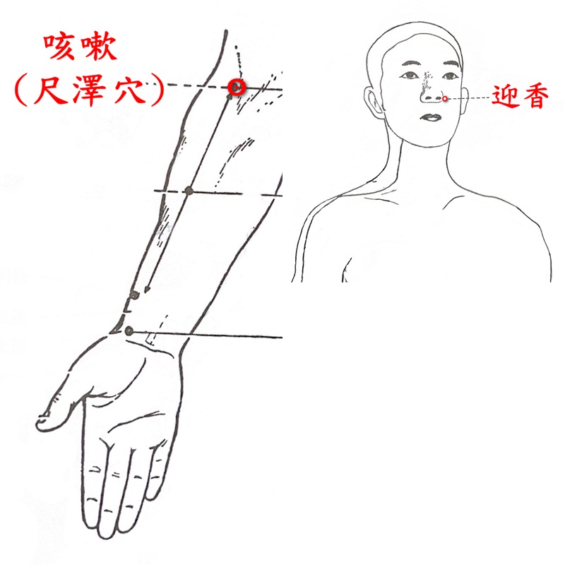 針灸治療